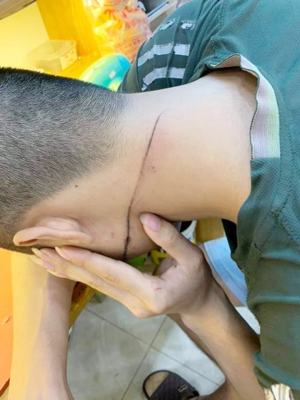 Hình ảnh một nạn nhân bị quạt rơi trúng cổ đã lành